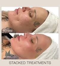 Under Eye Bags Treatment In Danville